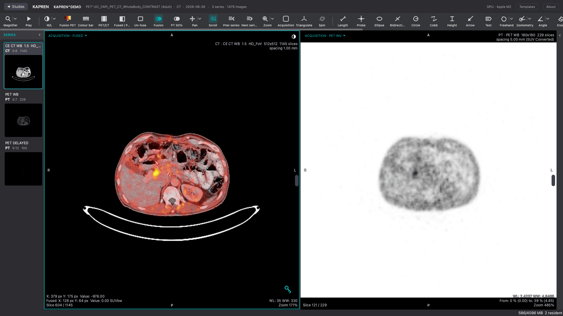PET/CT Fusion — PET laid over CT with a blend control — the fused planes, the side-by-side view, and the PET alone.