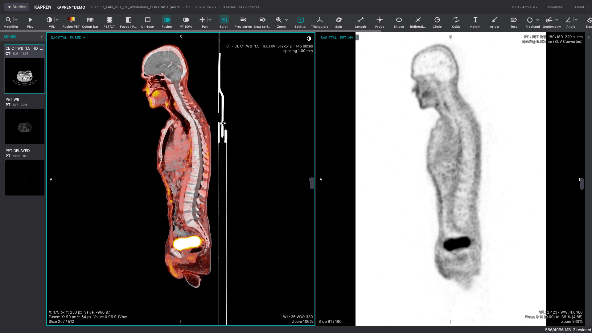 PET/CT Fusion — PET laid over CT with a blend control — the fused planes, the side-by-side view, and the PET alone.