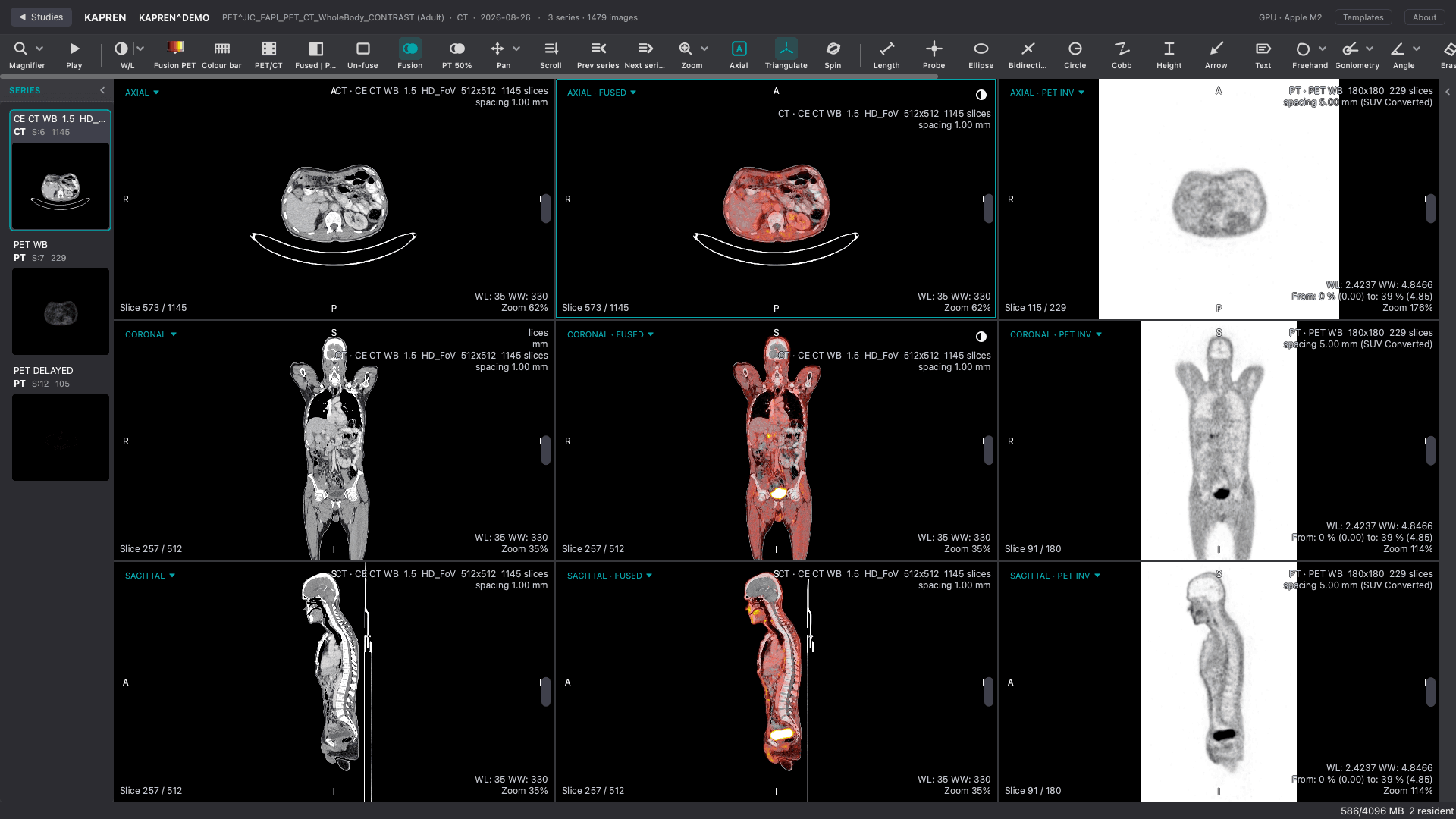 PET/CT Fusion — PET laid over CT with a blend control — the fused planes, the side-by-side view, and the PET alone.